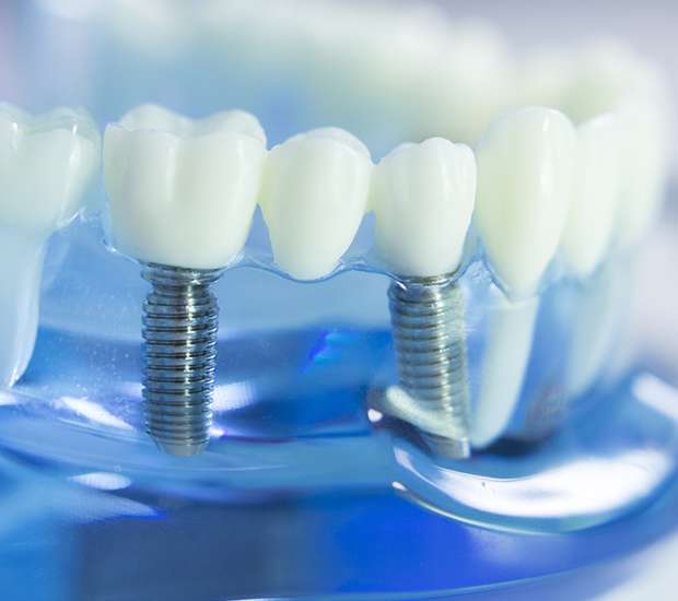 Lewisburg Dental Implants